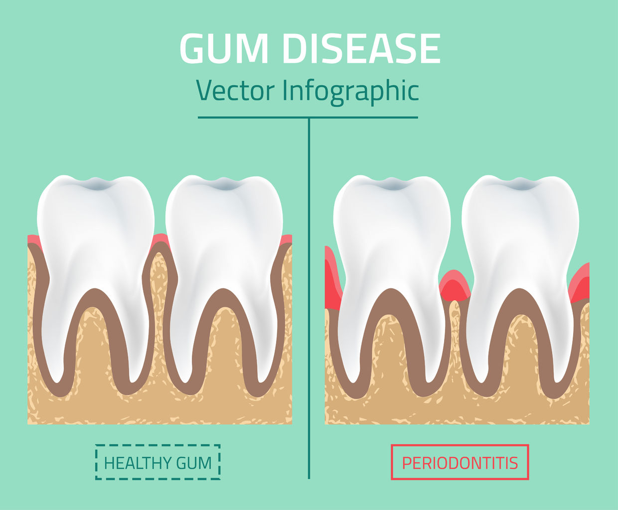 Periodontal Gum Disease and Cannabis